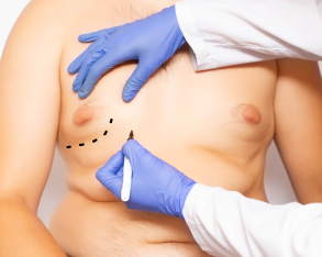 Korekta ginekomastii – chirurgiczna korekcja męskich piersi